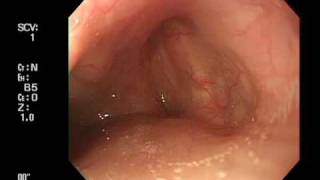 Endoscoe insertion from right pyriform sinus [upl. by Alleul661]