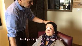 pansement rhinoplastie Tunisie [upl. by Norrag]