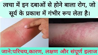 photosensitive eruption eczema disease फोटोसुग्रहित विस्फोट छाजन रोग का कारण लक्षण और संपूर्ण इलाज [upl. by Hcelemile]