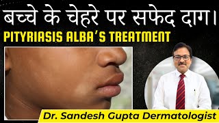 White patch on face Is this Vitiligo Or Pityriasis Alba बच्‍चे के चेहरे पर सफेद दाग। [upl. by Nahc]