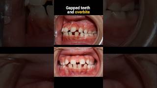 Braces for gapped teeth and overbite braces orthodontist bracesoff dentist [upl. by Dubenko]