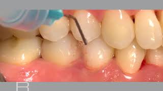 Nonsurgical treatment of periodontitis and periimplant mucositis [upl. by Joscelin77]