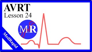 Atrioventricular Reentrant Tachycardia AVRT [upl. by Araiek]