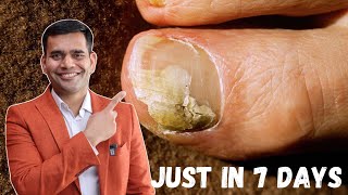 Just in 7 Days Cure Toenail Fungus At Home  Best Remedy For Toenail Fungus  Dr Vivek Joshi [upl. by Piero]