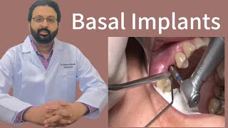 Mastering Basal Implants A Comprehensive Guide to Revolutionary Tooth Replacement Solutions [upl. by Seana]