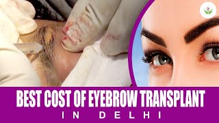 Best Cost of Eyebrow Transplantation in Delhi by Dr Sandeep Bhasin  Care Well Medical Centre [upl. by Arramas]