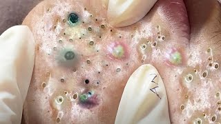 Big Cystic Acne Blackheads Extraction Blackheads amp Milia Whiteheads Removal Pimple Popping  395 [upl. by Llerral]