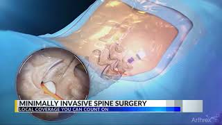 CBS 42 Highlights Arthrexs UltraMinimally Invasive Spine Surgery Techniques [upl. by Ohare150]