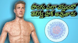 chicken pox telugu  chicken pox treatment telugu  pongu  ammavaru  atalamma [upl. by Horne807]