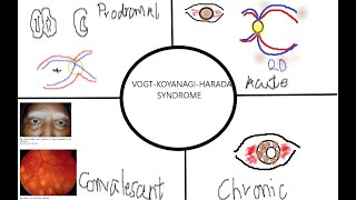 VOGT KOYANAGI HARADA SYNDROME KanskiSeries 2022 [upl. by Naltiak364]