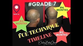 GRADE 7 Baldness with FUE Hair Transplant Technique [upl. by Barret10]