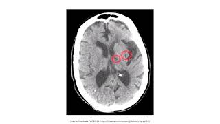 Cerebrovascular Disease for the USMLE Step 1 [upl. by Eidnak]