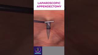 Laparoscopic Appendectomy  Appendicitis Treatment [upl. by Aronid]