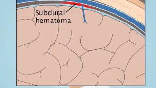 Understanding Subdural Hematoma [upl. by Lorsung]