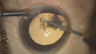 Phaco in an eye with IRIS COLOBOMA [upl. by Nichani3]