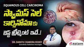 BEST treatment for squamous cell carcinoma  DrSarath Chandra Reddy  Kaizen Hematology Network [upl. by Itsirhc]