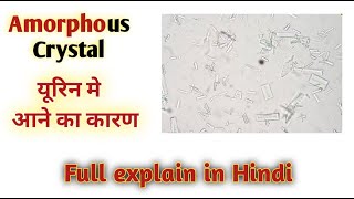 amorphous crystals in urine  causes of amorphous urate  Amorphous crystal in urine [upl. by Guevara]