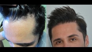 Frontal Hairline Restoration  Hairline implants Dr Doganay [upl. by Ssilb]