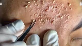 Acne amp Blackhead Treatment Blackhead Removal on forehead  Remove Blackhead removeblackhead [upl. by Eelinnej]