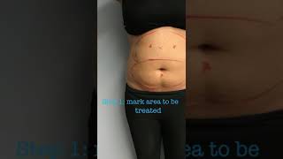 Full CoolSculpting Treatment with Before and Afters [upl. by Jo-Anne678]