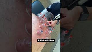 Cupping Therapy for Back Pain [upl. by Dannel]