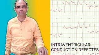 INTRAVENTRICULAR CONDUCTION DEFECTES [upl. by Blader]