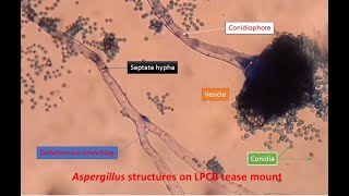 Aspergillus structures in LPCB tease Mount [upl. by Monson879]