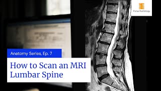 How to Scan an MRI Lumbar Spine [upl. by Aubrey618]