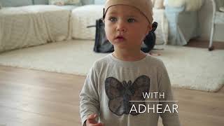 MEDELs ADHEAR Hearing with Microtia and Atresia [upl. by Dagnah]