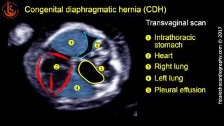 Fetal echocardiography at 1113 weeks Congenital Diaphragmatic Hernia CDH [upl. by Cioffred]