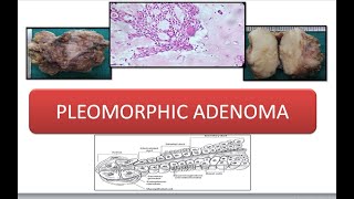 Pleomorphic Adenoma [upl. by Flessel813]