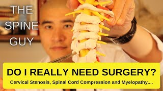 Cervical Stenosis Spinal Cord Compression and Myelopathy DO I REALLY NEED SURGERY [upl. by Attena]