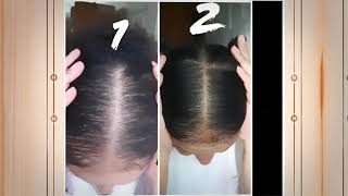 Female Pattern Hair Loss Success Stories [upl. by Schuman785]