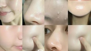 Get clear skin in 2 weeks [upl. by Saimerej852]