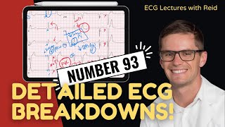 Improve your EKG Skills test yourself  ECG No 93 [upl. by Nivloc]