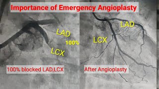 Emergency Angioplasty of 100 Blocked LAD LCX l Stenting of LAD LCX l Hindi [upl. by Acinoed]