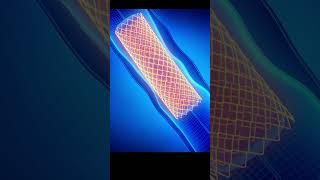 3D Animation of Angioplasty Heart Procedure Medical Animation Explained [upl. by Alvina]