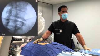 Radiofrequency Ablation Procedure [upl. by Ttsepmet]