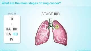 Staging of Lung Cancer [upl. by Hera]