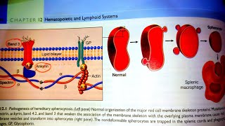 Hereditary SpherocytosisPathology of Hereditary SpherocytosisPathogenesis of HSRobins pathology [upl. by Arretahs]