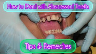 How to Deal with Abscessed Teeth Tips amp Remedies [upl. by Ramsey]