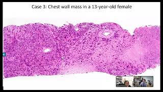 In this video David Papke PapkeDavid and I discuss four emerging mesenchymal tumors [upl. by Coulter218]