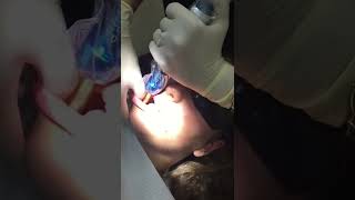 Numbing without needles Dental [upl. by Ettelocin]