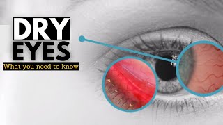 Dry Eye Syndrome Causes Signs and Symptoms Diagnosis and Treatment [upl. by Wetzel]