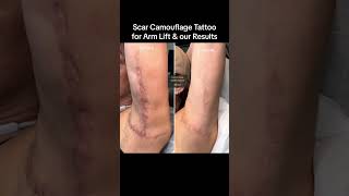 I Got A Tattoo To Cover My Arm Lift Scars scarcamouflagesuccessstories scarcamouflage [upl. by Edi]