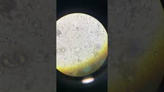 Budding Yeast Cells and High Pus Cells in Urine UNDER MICROSCOPE [upl. by Lleuqram]