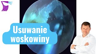 Usuwanie Woskowiny — Widok z Endoskopu Usuwanej Woskowiny [upl. by Enirac]