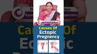 Causes of Ectopic Pregnancy Understanding the Risks and Prevention  shorts ectopicpregnancy [upl. by Perot569]