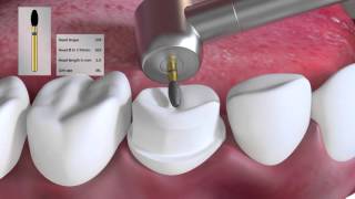 Crown preparation tutorial by Prof Brian Millar [upl. by Fillbert616]