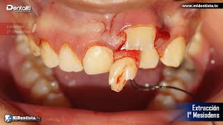 MESIODENS ¬ Dientes Supernumerarios  Cirugía  Dr Omar Noriega Gtz  wwwmidentistatv [upl. by Truman]